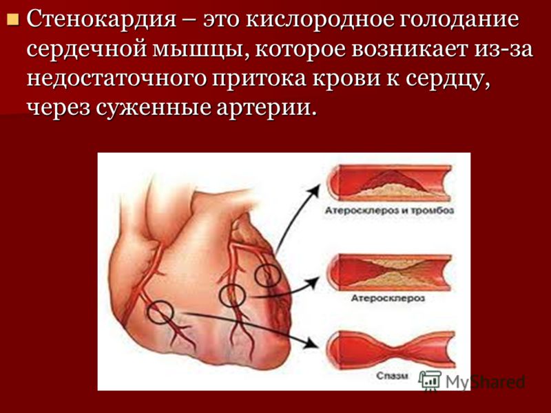 Стенокардия