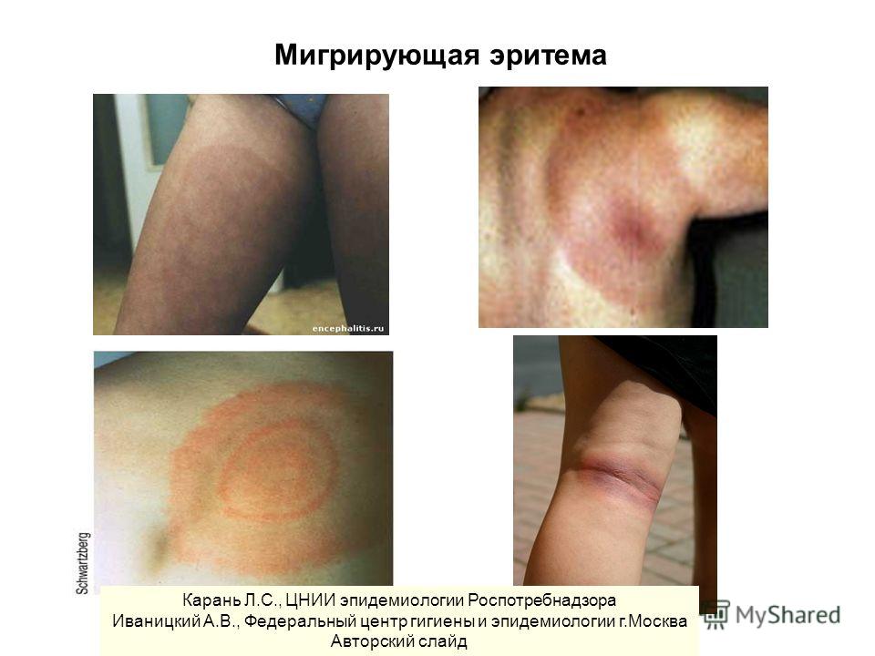 Мигрирующая эритема