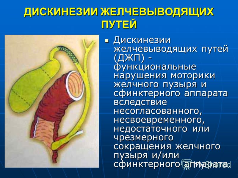 Дискинезия желчевыводящих путей