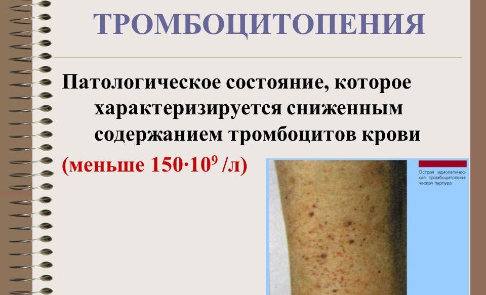 Тромбоцитопения