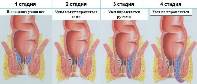 Стадии геморроя