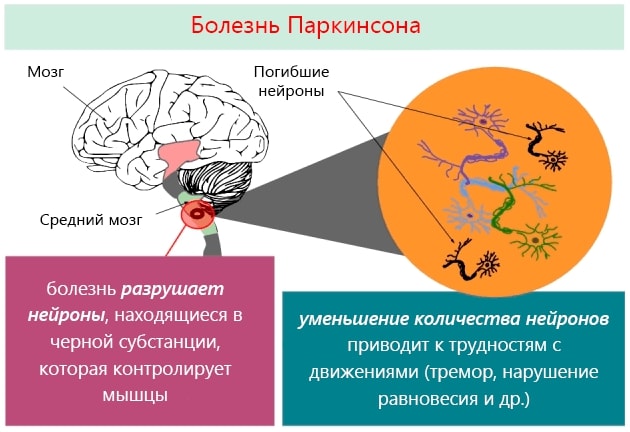 Болезнь Паркинсона
