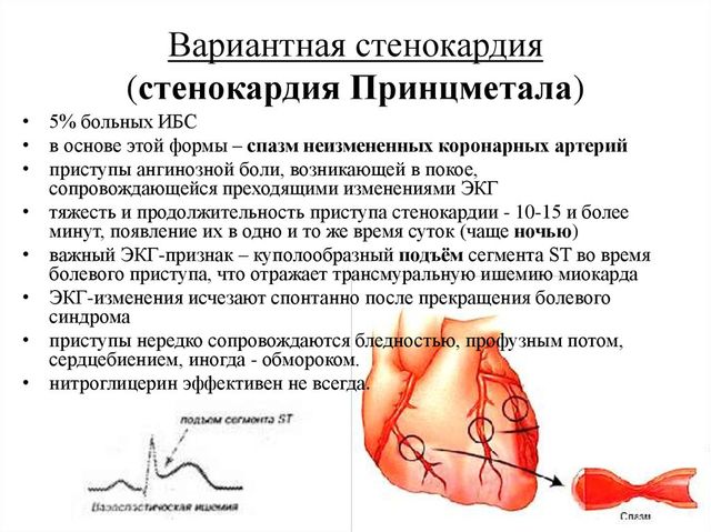 Стенокардия Принцметала