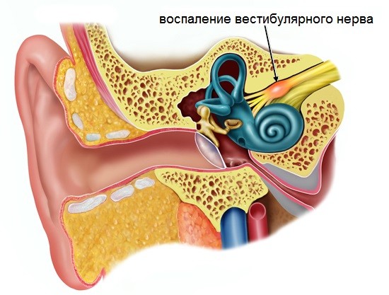 Вестибулярный нейронит