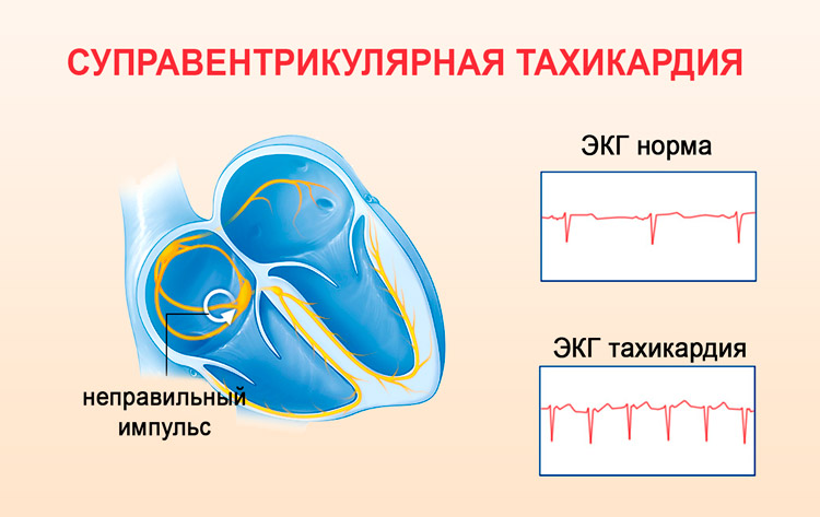 Тахикардия