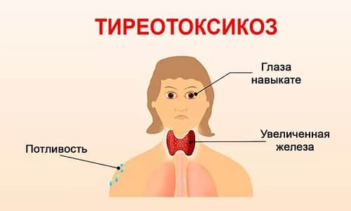 Тиреотоксикоз