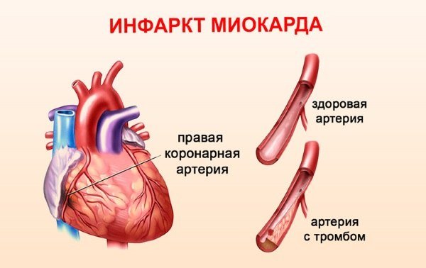 Инфаркт