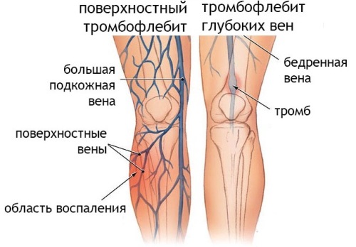 Тромбофлебит