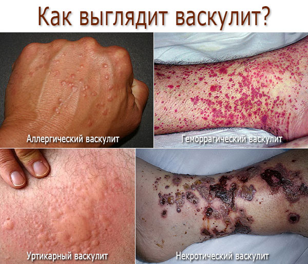 Васкулит