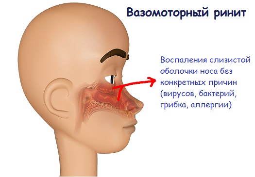 Вазомоторный ринит 