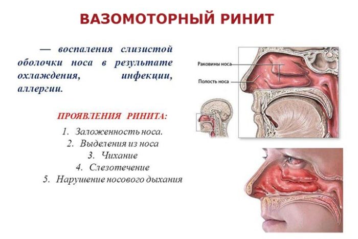 Ринит