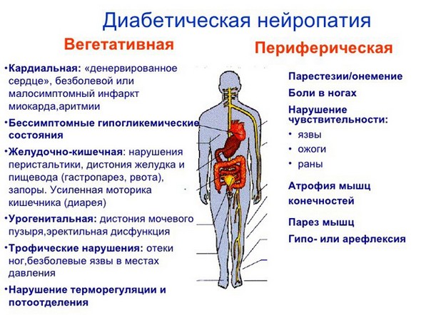 Диабетическая нейропатия