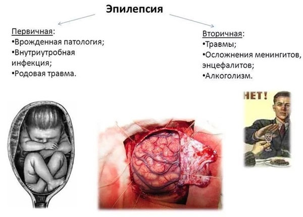 Виды эпилепсий