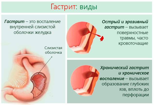 Гастрит