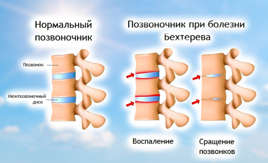 Болезнь Бехтерева