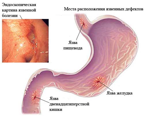Язва органов ЖКТ