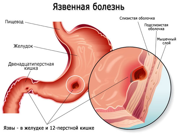 Язва органов ЖКТ