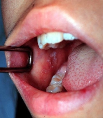 Проявления кори в ротовой полости Проявления кори в ротовой полости