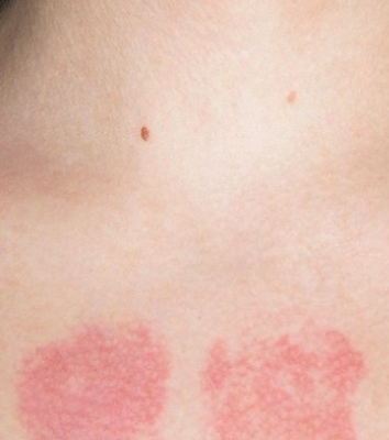 Ожоговые пятна Ожоговые пятна