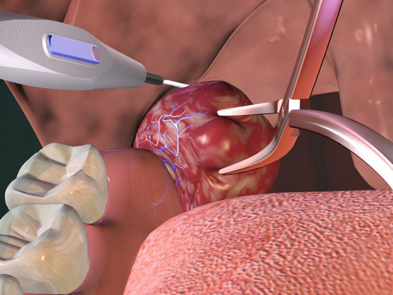 Удаление миндалин лазером.