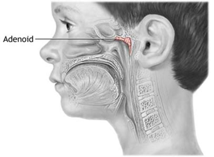 adenoidy