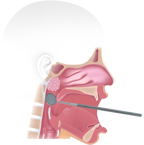 Adenoidyi-u-detey-simptomyi-sposobyi-lecheniya-prichinyi-vozniknoveniya_6730
