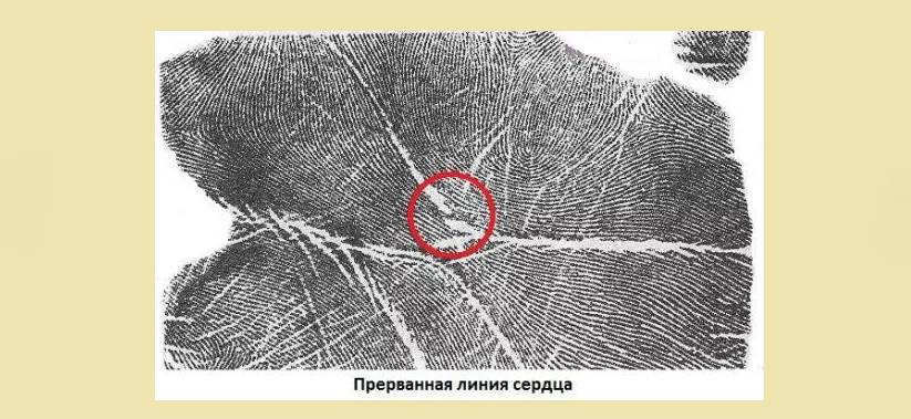 Прерывистый участок в области бороздки сердца