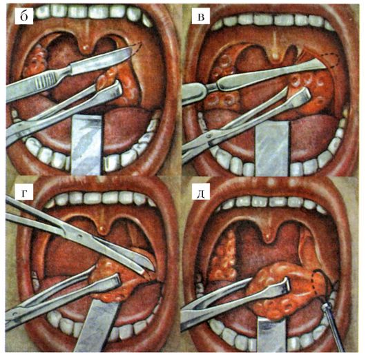 Удаление глан скальпелем.