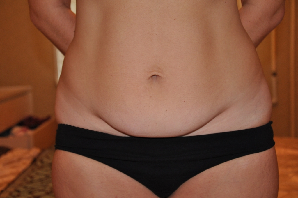 Обвисший после кесарева живот